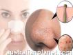 Remove blackheads from nose