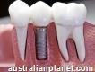 Dental Implants Melbourne, Manningham & Bulleen Denture Implants Retained Crowns