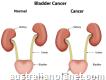 Bladder Cancer Treatment in India Healing Touristry