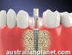 Dental Implants Melbourne Holistic Dental Brunswick