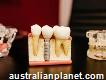 Cheap Dental Implants Australia
